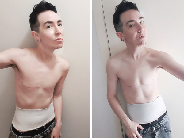 6-7 weeks post-op.